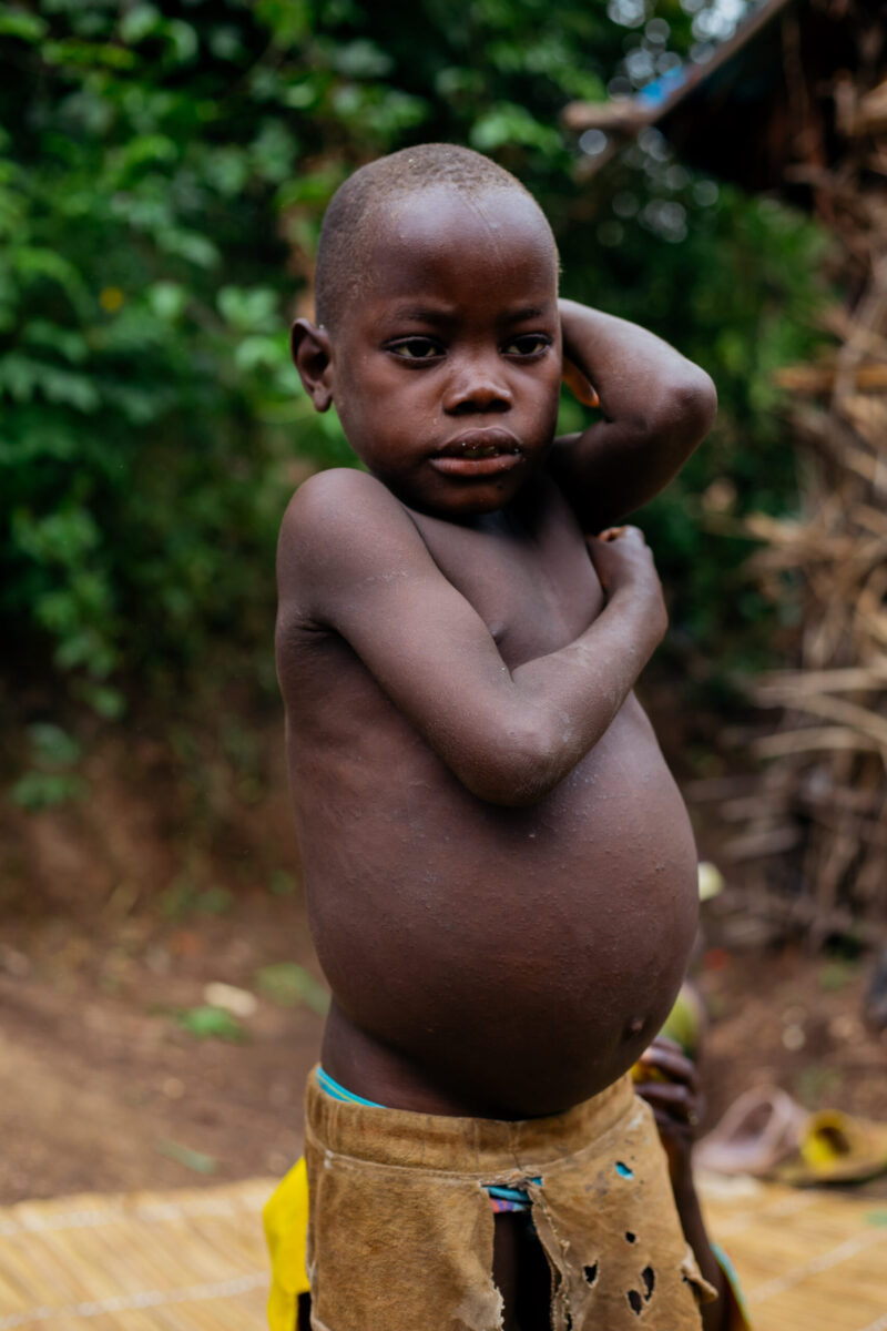 Unterernährtes Kind mit Hungerbauch in Burundi – Spendenprojekt hilft Kindern in extremer Armut mit lebensnotwendiger Nahrung und medizinischer Versorgung.