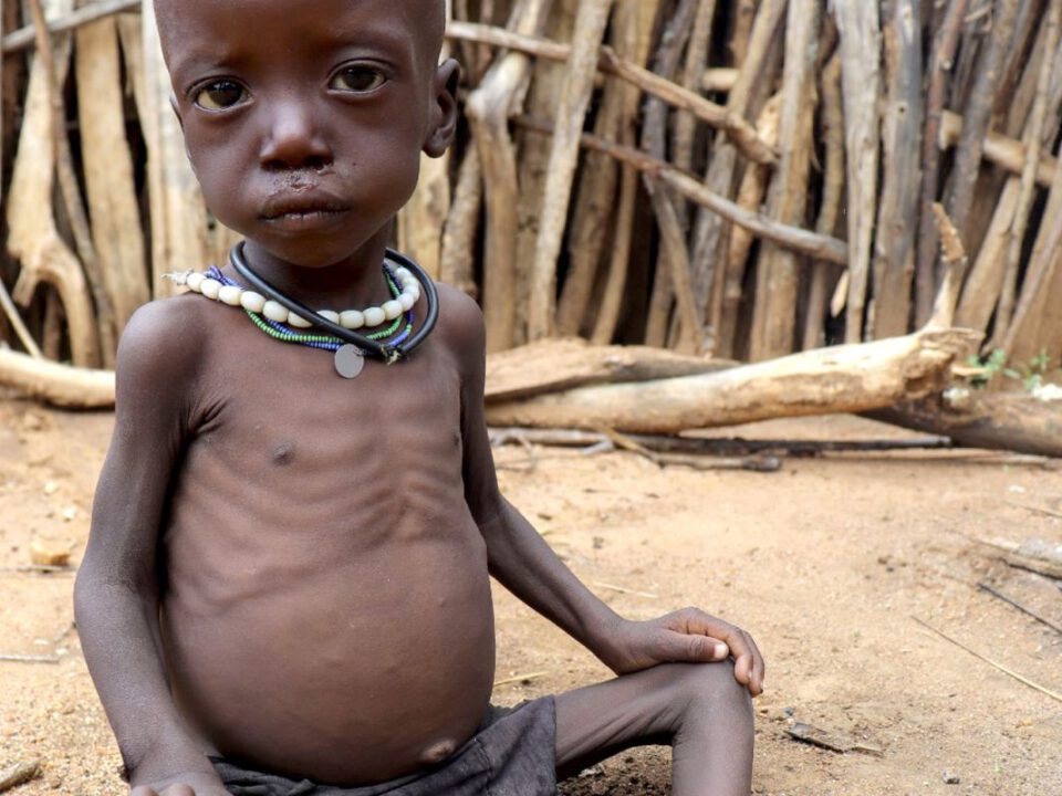 Schwer unterernährtes Kind in Karamoja, Uganda, mit stark hervortretenden Rippen und aufgeblähtem Hungerbauch – Symbol der dramatischen Ernährungskrise in Ostafrika.